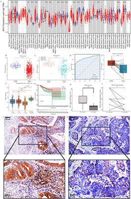 The immunological and prognostic significance of the diabetes mellitus-related gene WFS1 in endometrial cancer